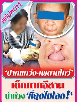 ปากแหว่ง เพดานโหว่