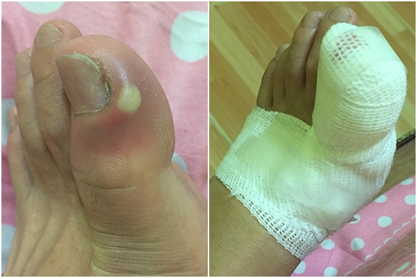 ตัดเล็บผิดวิธี ตัดเล็บผิดวิธี