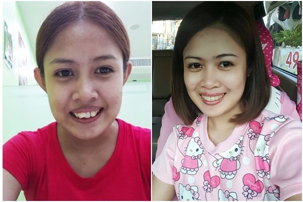 รีวิวจัดฟัน รีวิวจัดฟัน