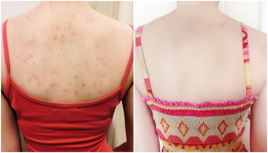 เคล็ดลับหลังขาวใส เคล็ดลับหลังขาวใส