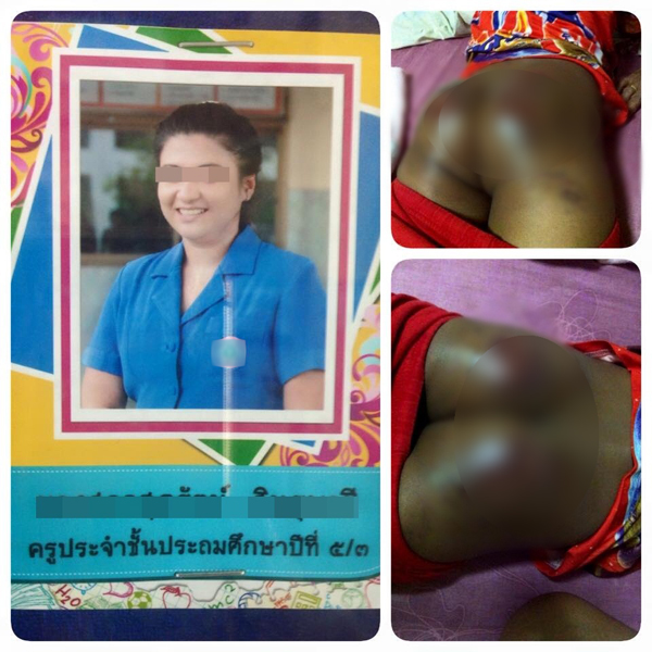 สาวโพสต์อ้าง หลานถูกครูตีจนก้นช้ำ แค่ไม่ทำการบ้านเพราะป่วย สาวโพสต์อ้าง หลานถูกครูตีจนก้นช้ำ แค่ไม่ทำการบ้านเพราะป่วย