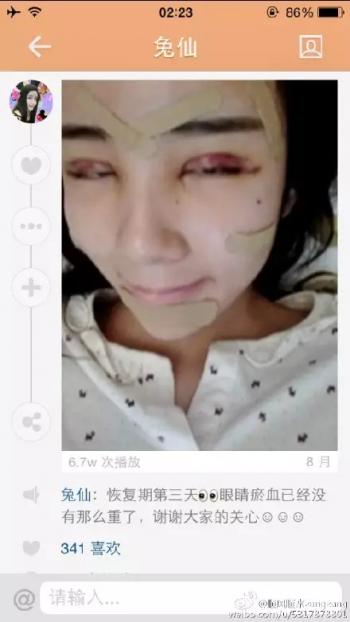 เน็ตไอดอลจีนทำศัลยกรรม เน็ตไอดอลจีนทำศัลยกรรม