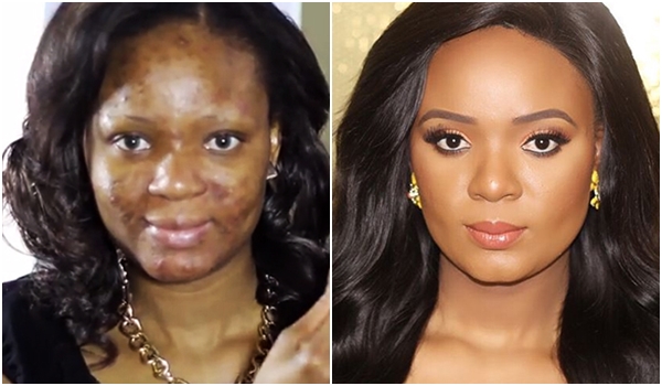 วิธีแต่งหน้าปิดสิว วิธีแต่งหน้าปิดสิว