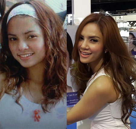 อุ้ม ลักขณา ศัลยกรรม อุ้ม ลักขณา ศัลยกรรม