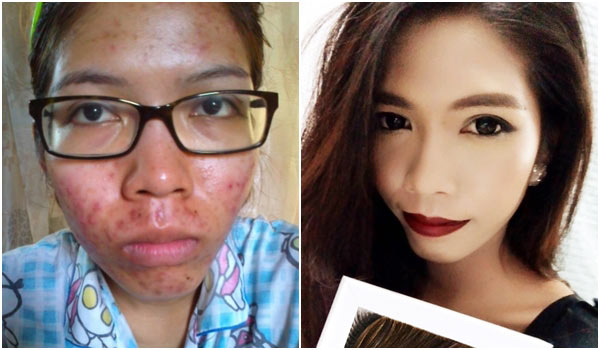 วิธีรักษาสิว วิธีรักษาสิว