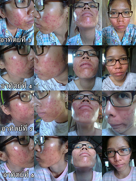 วิธีรักษาสิว วิธีรักษาสิว