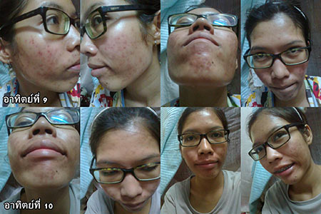 วิธีรักษาสิว วิธีรักษาสิว