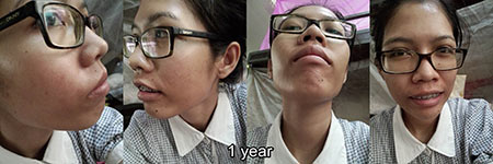 วิธีรักษาสิว วิธีรักษาสิว