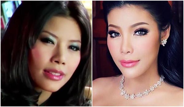 แหวนแหวน ศัลยกรรม แหวนแหวน ศัลยกรรม