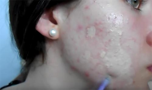 วิธีแต่งหน้าปิดสิว วิธีแต่งหน้าปิดสิว