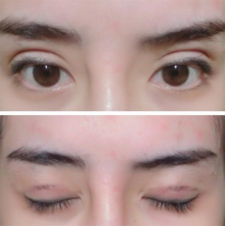 น้ำส้ม โซมี่ ศัลยกรรม น้ำส้ม โซมี่ ศัลยกรรม