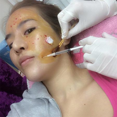 น้ำส้ม โซมี่ ศัลยกรรม น้ำส้ม โซมี่ ศัลยกรรม