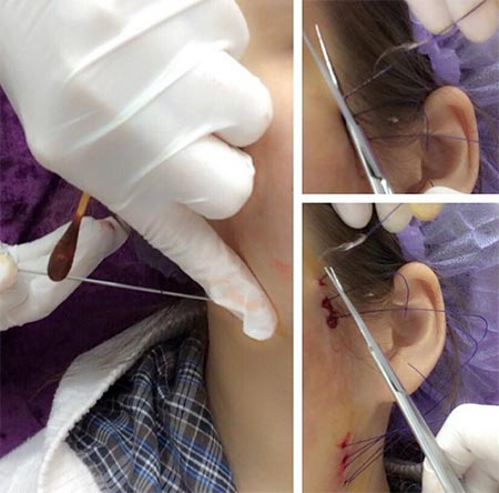 น้ำส้ม โซมี่ ศัลยกรรม น้ำส้ม โซมี่ ศัลยกรรม