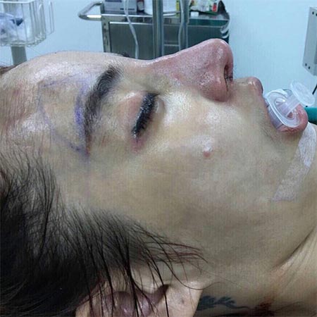 น้ำส้ม โซมี่ ศัลยกรรม น้ำส้ม โซมี่ ศัลยกรรม