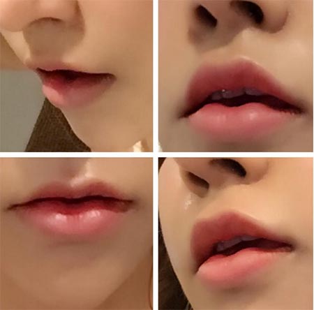 น้ำส้ม โซมี่ ศัลยกรรม น้ำส้ม โซมี่ ศัลยกรรม