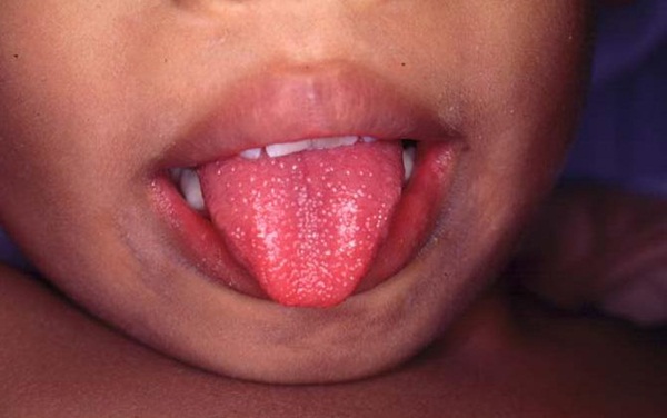 ลิ้นเป็นสีแดงสด ลิ้นเป็นสีแดงสด