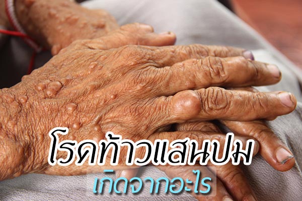 โรคท้าวแสนปม โรคท้าวแสนปม