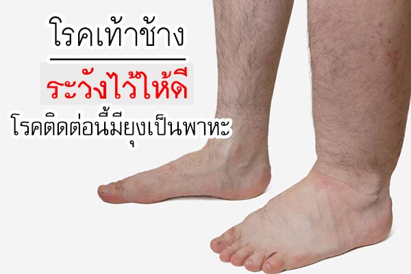 โรคเท้าช้าง โรคเท้าช้าง