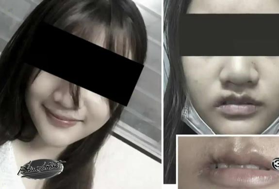 ศัลยกรรมปากเบี้ยว ศัลยกรรมปากเบี้ยว