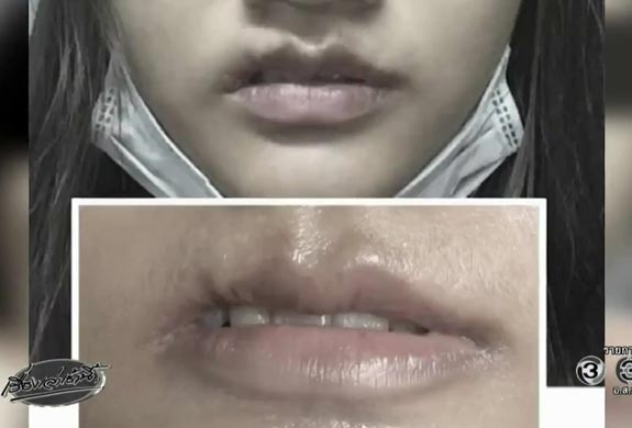 ศัลยกรรมปากเบี้ยว ศัลยกรรมปากเบี้ยว