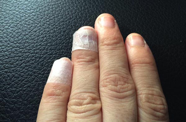 มือเท้าปาก มือเท้าปาก