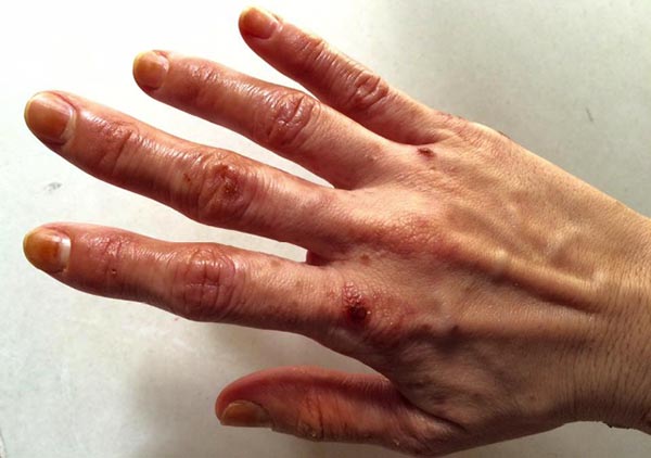 มือเท้าปาก มือเท้าปาก