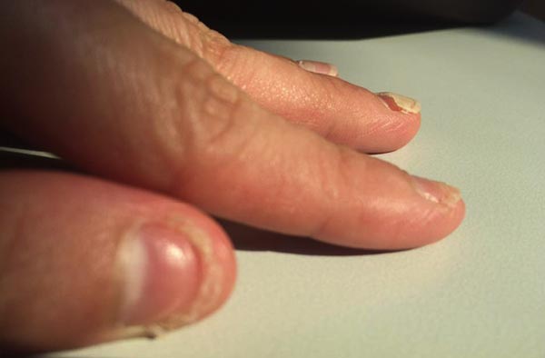 มือเท้าปาก มือเท้าปาก