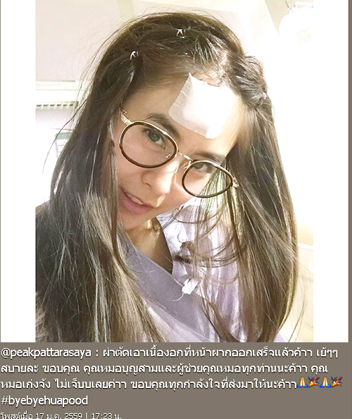 พีค ภัทรศยา ผ่าตัดเนื้องอกที่หน้าผาก พีค ภัทรศยา ผ่าตัดเนื้องอกที่หน้าผาก