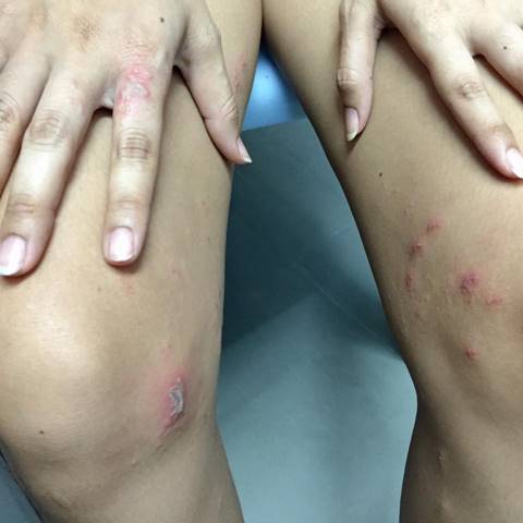 เตือนภัย ! แมลงก้นกระดก หรือแมลง Freshy ระบาดหน้าฝน พิษแรง แผลไหม้ลามเร็ว เตือนภัย ! แมลงก้นกระดก หรือแมลง Freshy ระบาดหน้าฝน พิษแรง แผลไหม้ลามเร็ว