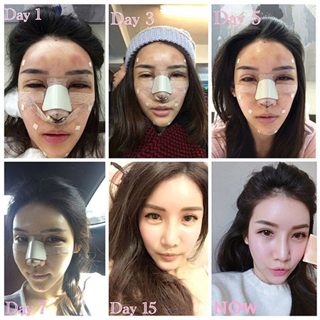 ศัลยกรรมเกาหลี ศัลยกรรมเกาหลี