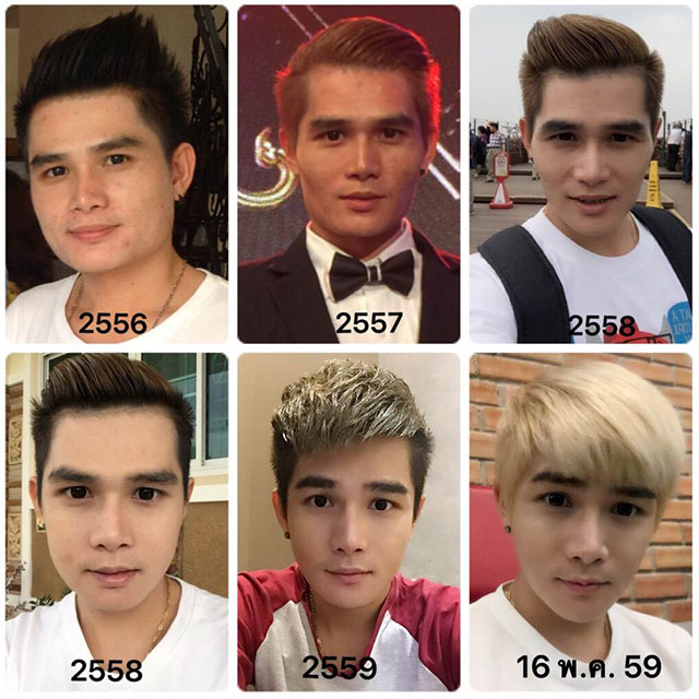 ผู้ชายทําศัลยกรรม ผู้ชายทําศัลยกรรม