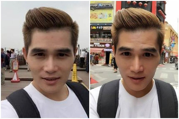ผู้ชายทําศัลยกรรม ผู้ชายทําศัลยกรรม