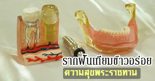 รากฟันเทียม รากฟันเทียม