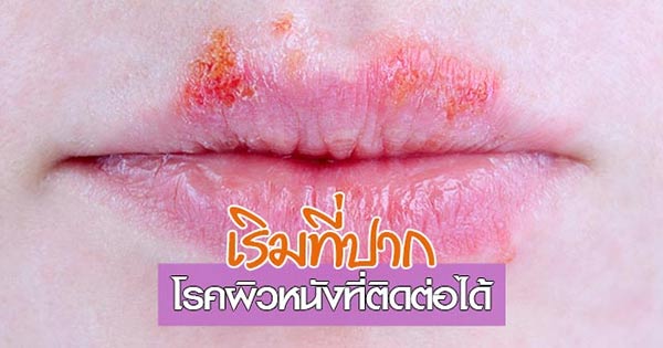 โรคติดต่อทางน้ำลาย โรคติดต่อทางน้ำลาย