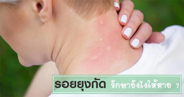 รักษารอยยุงกัด รักษารอยยุงกัด