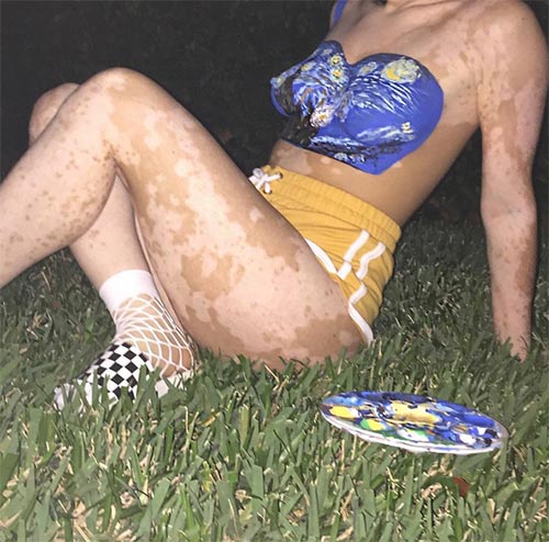 โรคด่างขาว โรคด่างขาว