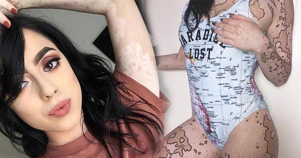 โรคด่างขาว โรคด่างขาว