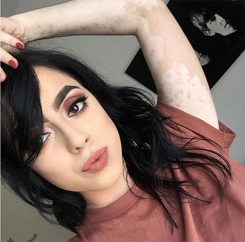 โรคด่างขาว โรคด่างขาว