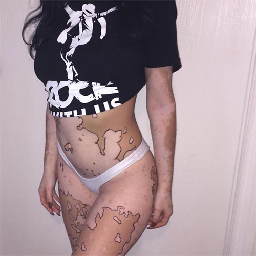 โรคด่างขาว โรคด่างขาว