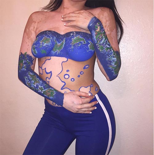 โรคด่างขาว โรคด่างขาว