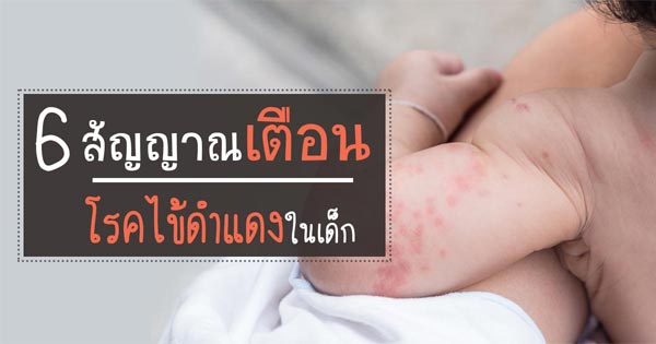 ไข้ดำแดง ไข้ดำแดง