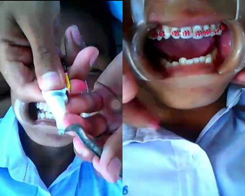 จัดฟัน จัดฟัน