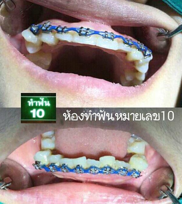 จัดฟัน จัดฟัน