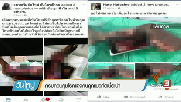 โรคเนื้อเน่า โรคเนื้อเน่า