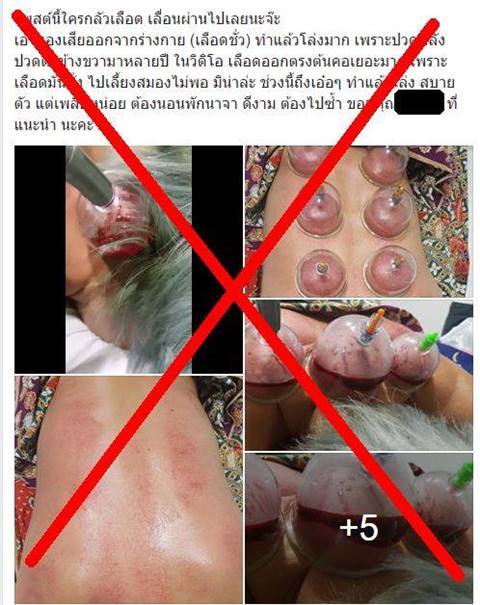 แชร์สนั่น ! ถ้วยเลือดบำบัด ดูดเลือดชั่วจากร่างกาย อ.เจษฎา เตือนให้ระวัง แชร์สนั่น ! ถ้วยเลือดบำบัด ดูดเลือดชั่วจากร่างกาย อ.เจษฎา เตือนให้ระวัง