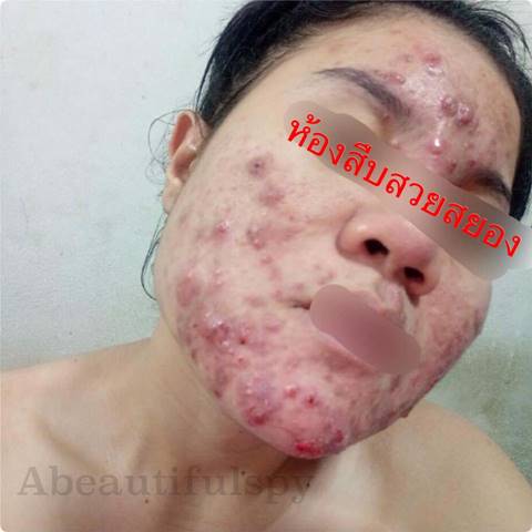 สาวระทม สั่งครีมหน้าเด้งในเน็ตมาใช้ สาวระทม สั่งครีมหน้าเด้งในเน็ตมาใช้