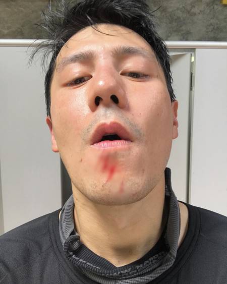 โดม หวิดเสียโฉมเกือบหมดหล่อ โดม หวิดเสียโฉมเกือบหมดหล่อ