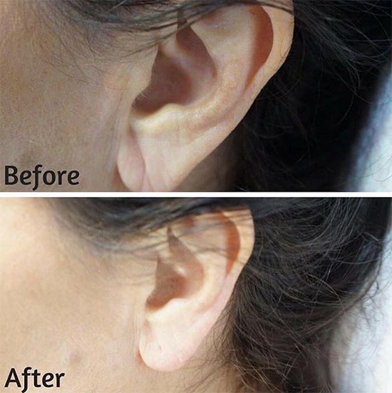 ฉีดฟิลเลอร์ ฉีดฟิลเลอร์