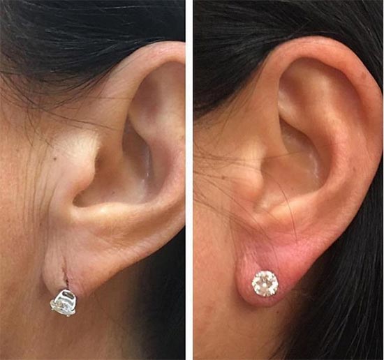 ฉีดฟิลเลอร์ ฉีดฟิลเลอร์