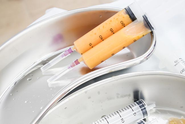 ฉีดไขมันที่หน้า ฉีดไขมันที่หน้า